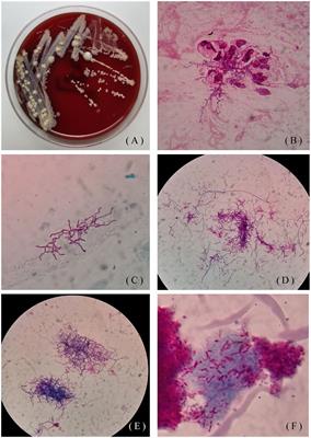 Two chronically misdiagnosed patients infected with Nocardia cyriacigeorgica accurately diagnosed by whole genome resequencing